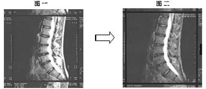 通过核磁共振观察到腰椎间盘突出减轻了(图)